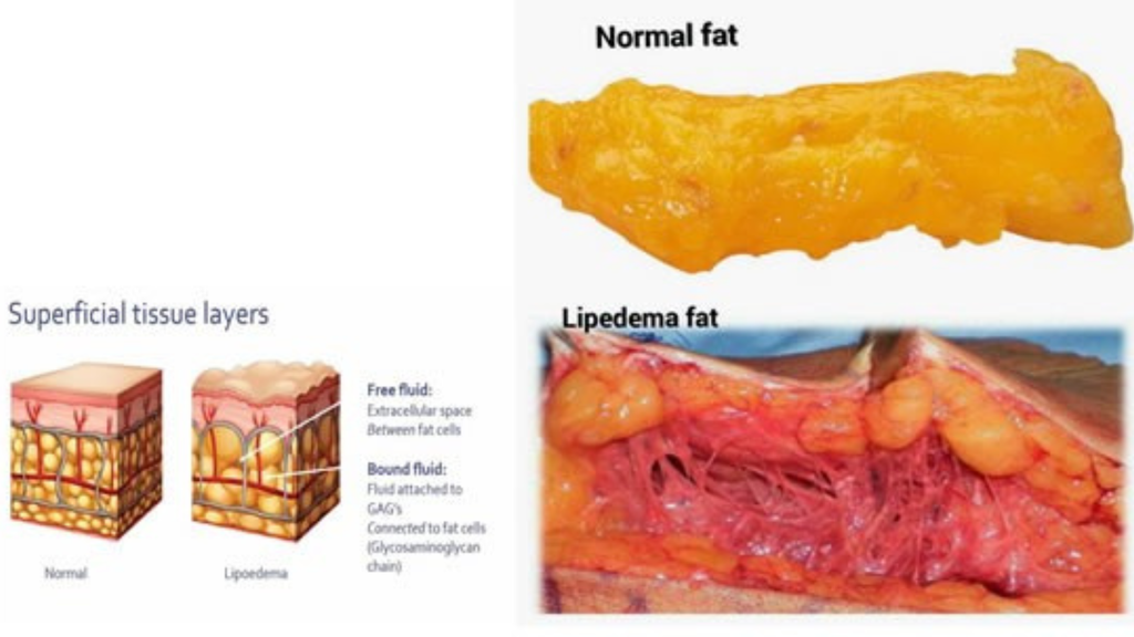 Lipoedema Awareness Month